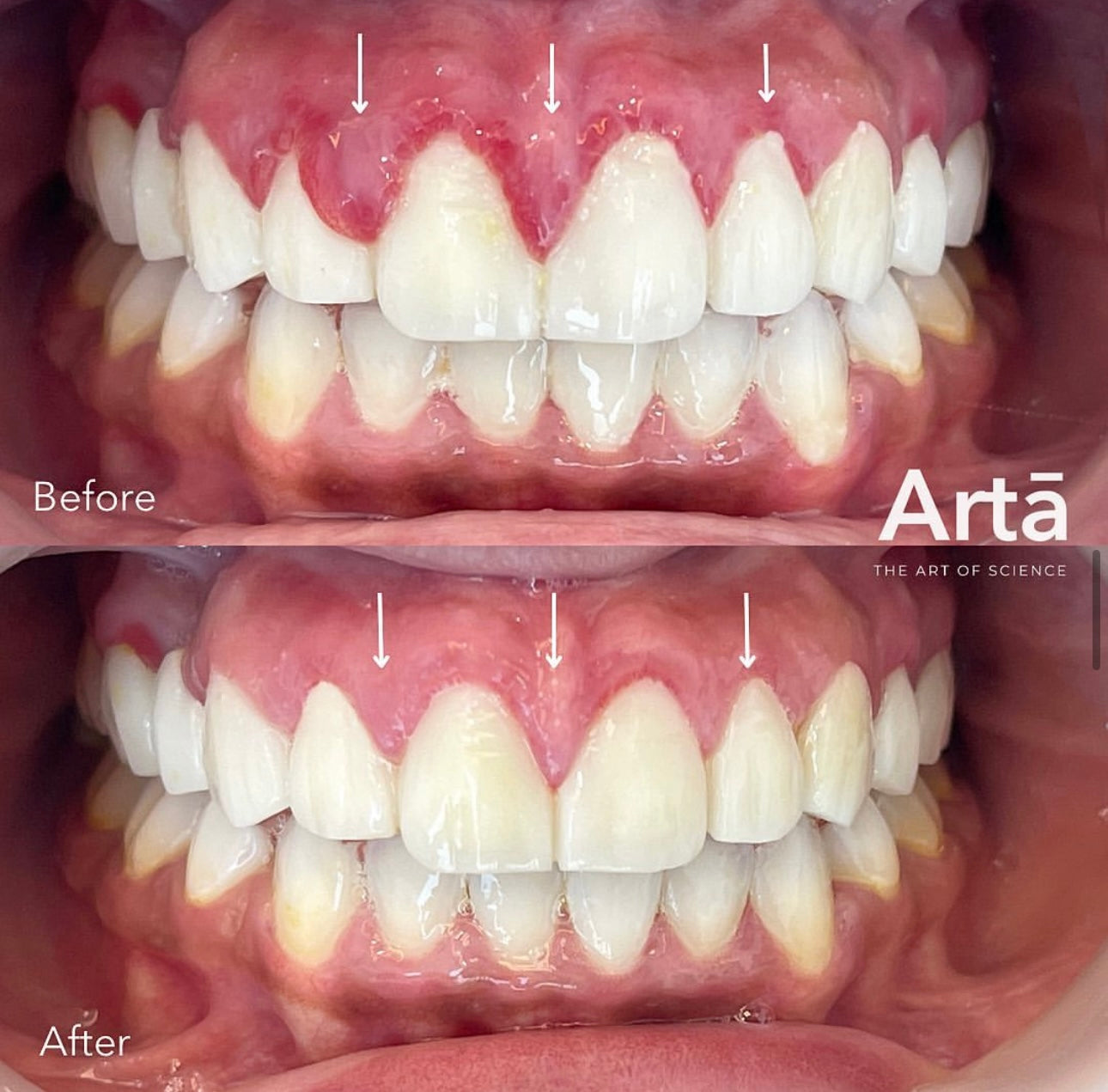 Mini Package – Complete Water Flosser Set