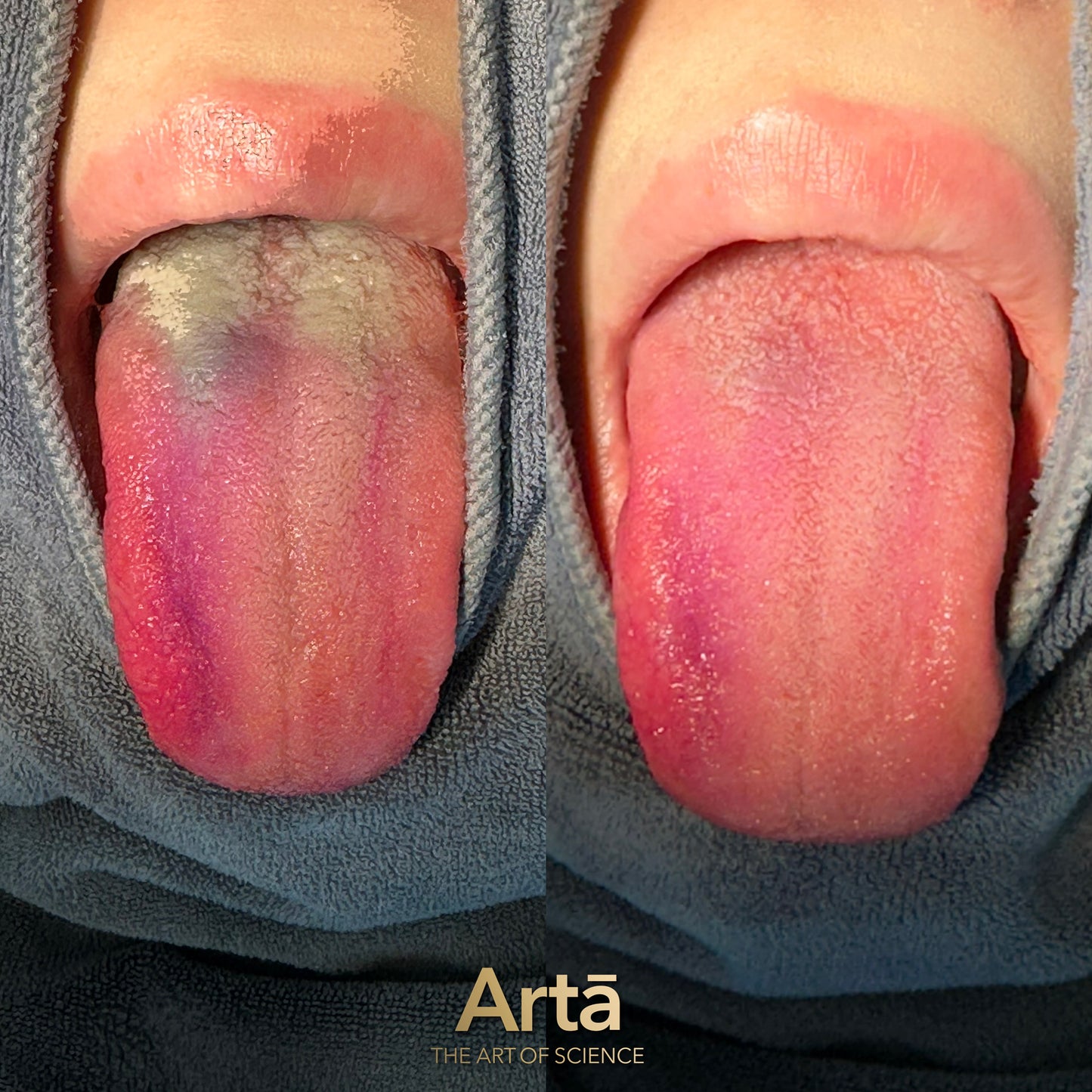 Before and after cleaning tongue with Arta copper scraper showing clear oral hygiene results | قبل وبعد تنظيف اللسان باستخدام كاشط اللسان النحاسي من آرتا لنتائج نظافة فموية واضح