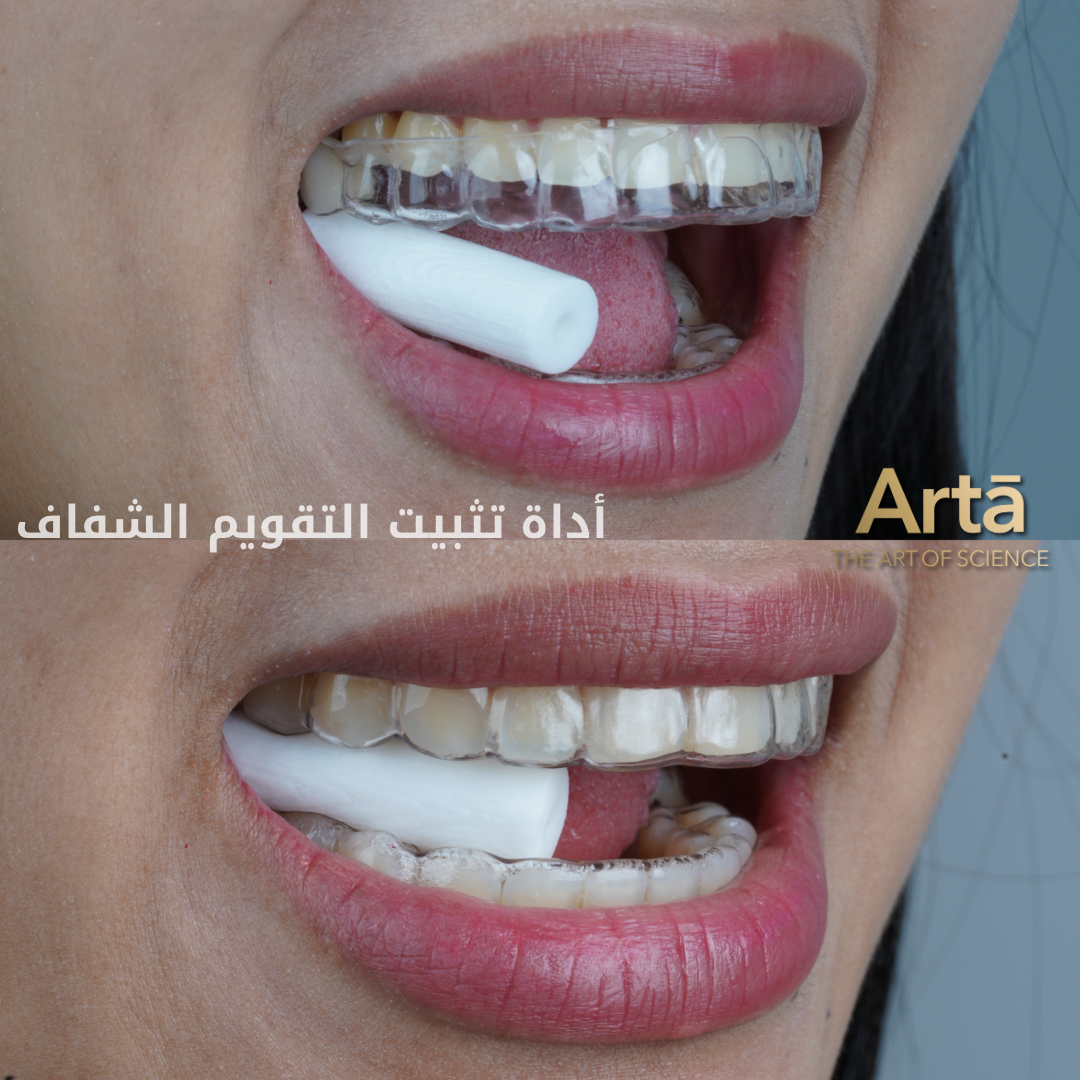 Arta clear aligner chewie tool | أداة آرتا لتثبيت التقويم الشفاف تعزز ثبات التقويم وتسرع النتائج لضغط مثالي وراحة فائقة أثناء الاستخدام اليومي